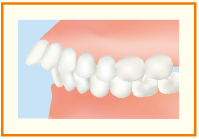 上顎前突イメージ